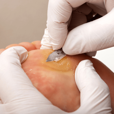 Callus Removal